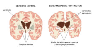 <cerebro-sano-versus-cerebro-con-enfermedad-de-Huntington>