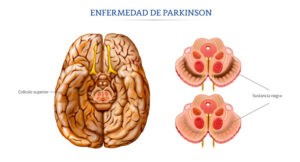 <comparacion-seccion-del-coliculo-superior-en-paciente-sano-versus-paciente-con-Parkinson>