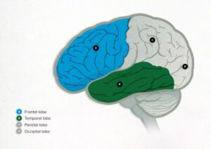 <dibujo-de-un-cerebro-afectado-por-demencia-frontotemporal-o-enfermedad-de-Pick>